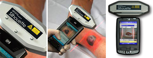Aranz Medical SilhouetteMobile (Images courtesy Aranz Medical)