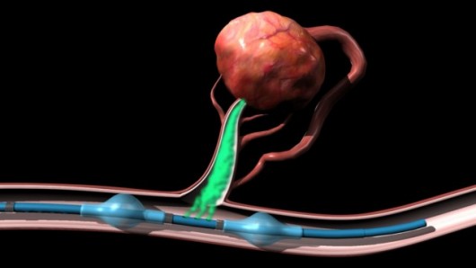 isoflow-direct-chemotherapy-chemo-tumour