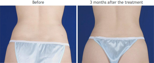 lipocontrol_2 LipoControl Laser Fat Removal System (Image courtesy Osyris Medical)