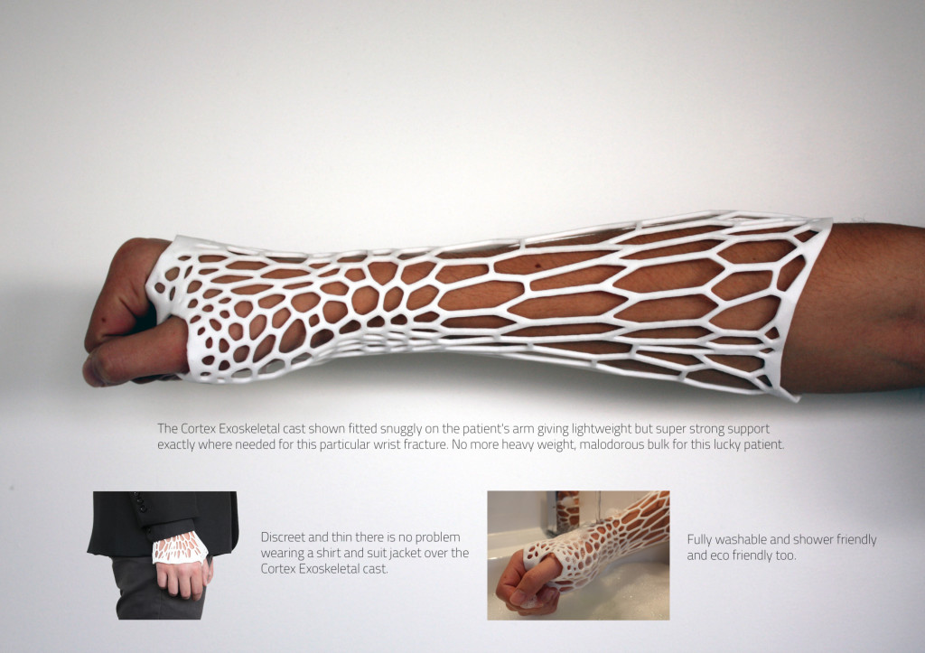 3D Printed Cast Lets You Scratch And Wash OhGizmo!